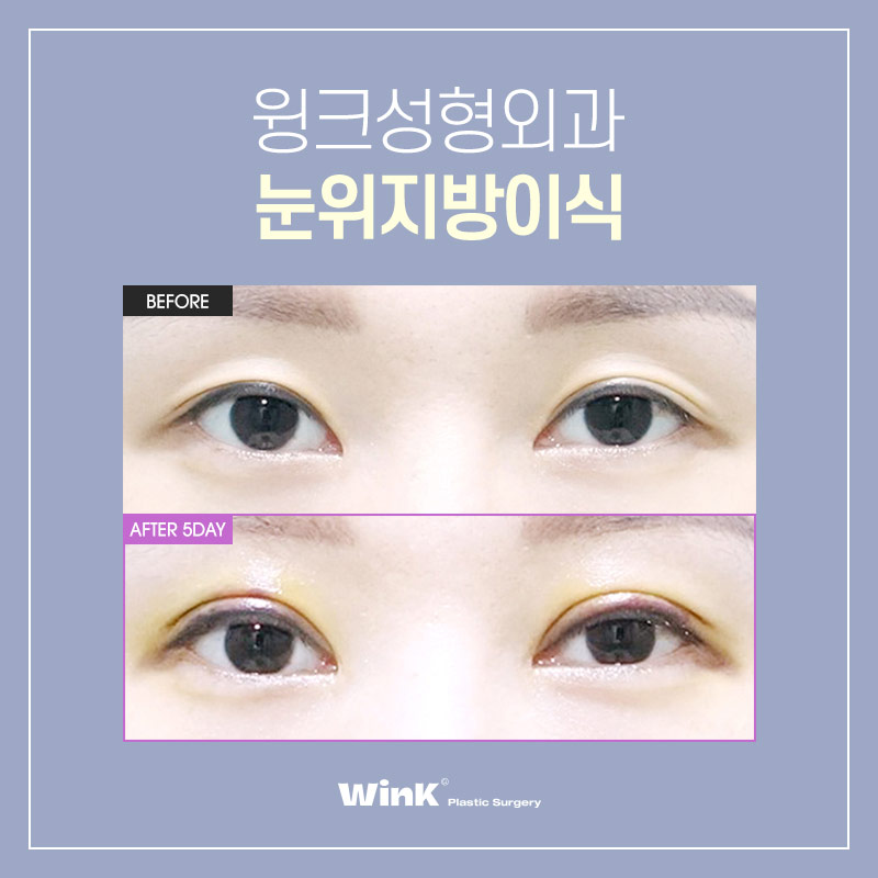 Let’s Restore Volume to Sunken Eyes with Wink Plastic Surgery’s Upper Eyelid Fat Grafting image 3