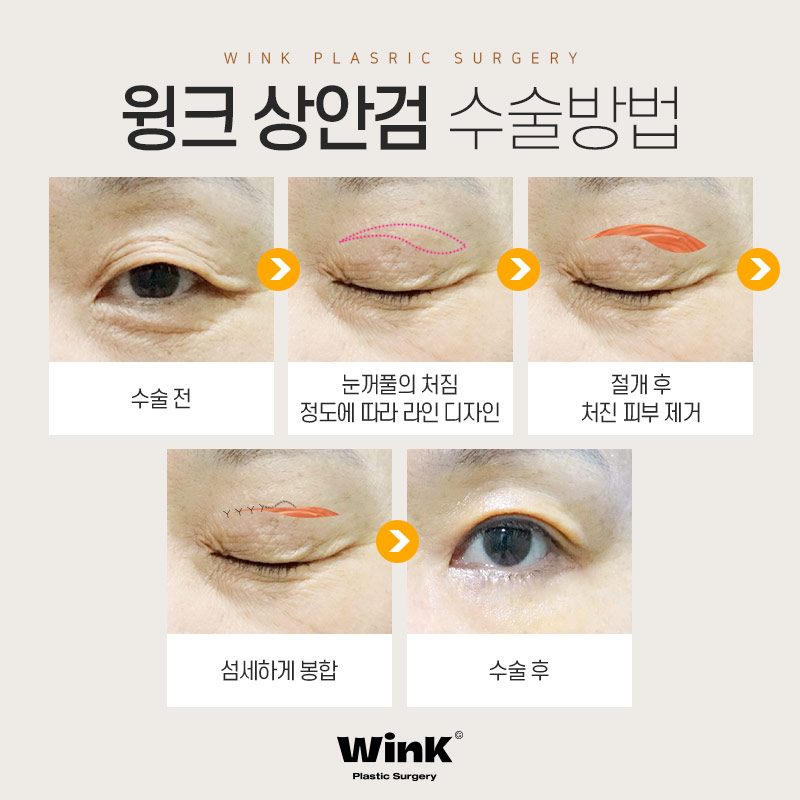 If You’re Worried About Sagging Eyes Due to Aging, WINK Plastic Surgery Upper Blepharoplasty image 4