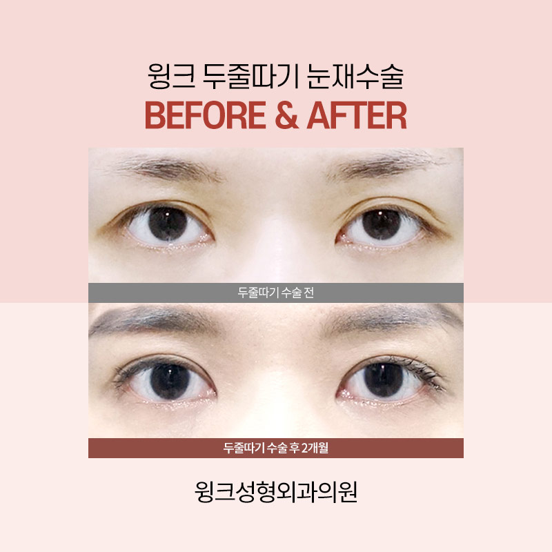 A sausage line can be improved with double-line blepharoplasty revision surgery. image 3