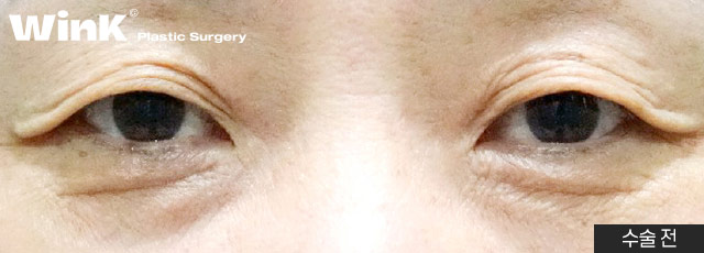 Sagging Eyelids That Have Lost Elasticity: A Youthful Eye Look with Upper Blepharoplasty at Wink Plastic Surgery image 5