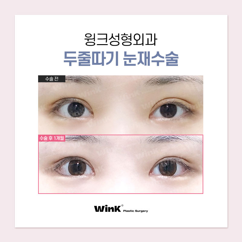 Thick, High Double Eyelid Lines and a Sausage-Like Eye! Solve It with Wink Double-Line Revision Surgery! image 9