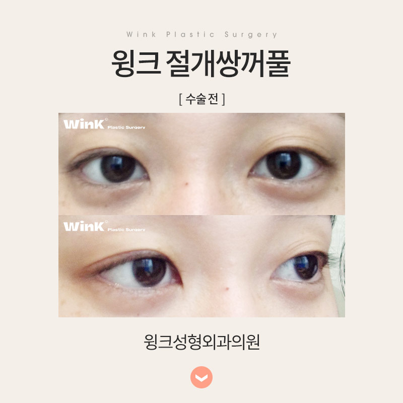 Let’s Learn About Incisional Double Eyelid Surgery image 3