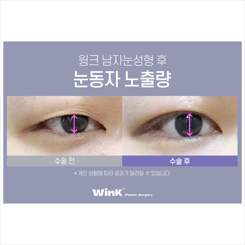 윙크성형외과 남자무쌍수술  남자눈매교정술 남자눈매교정비용 관련 이미지 4