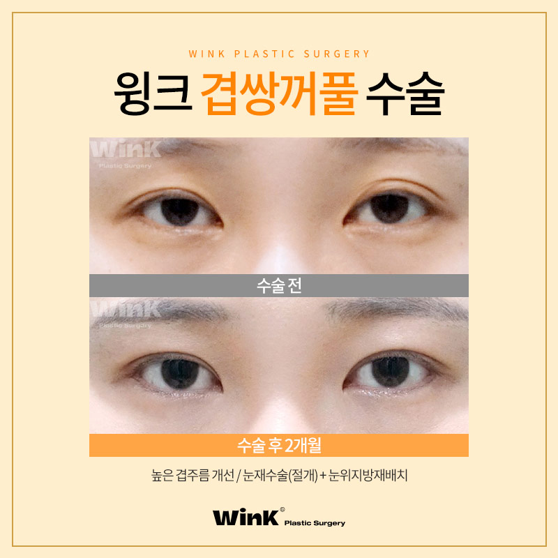 Can Double-Eyelid Surgery Be Done for Double-Fold Eyelids? Wink Plastic Surgery Explains! image 5