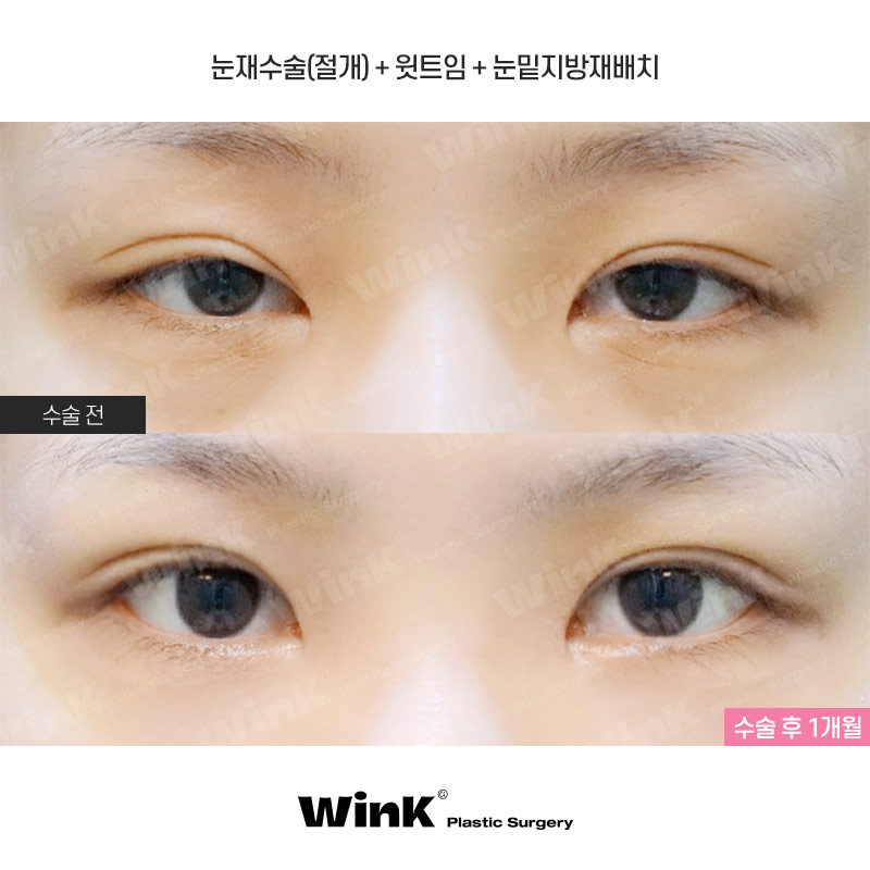 Wink Canthoplasty That Gently Lifts for a More Defined, Clear Eye Shape! image 1