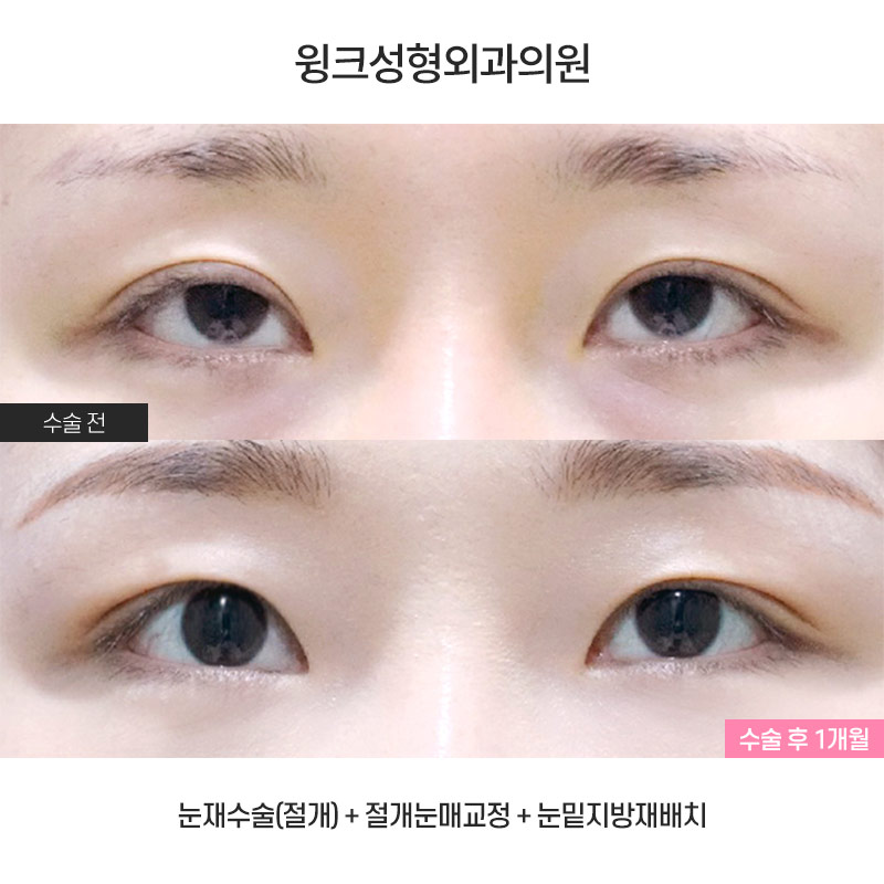 Let’s Take a Look at Double Eyelid Surgery for Droopy Eyes. image 1