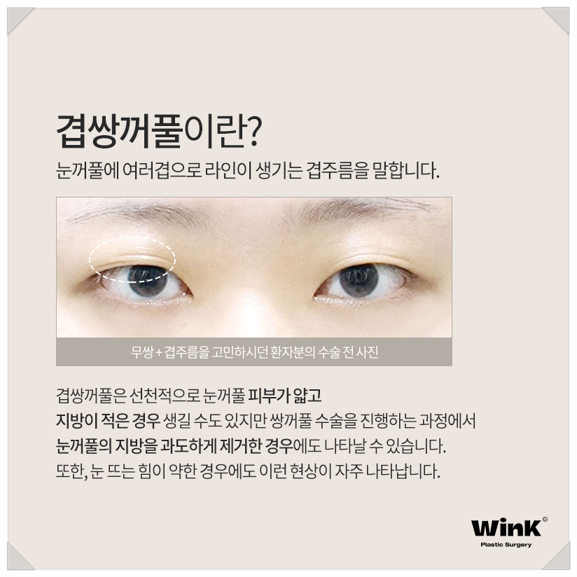 겹주름쌍꺼풀 쌍커풀여러겹 윙크성형외과  겹쌍 쌍커풀주름 관련 이미지 2