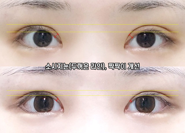 두줄따기 쌍꺼풀 라인낮추기로 부담스러운 눈매는 그만! 관련 이미지 6