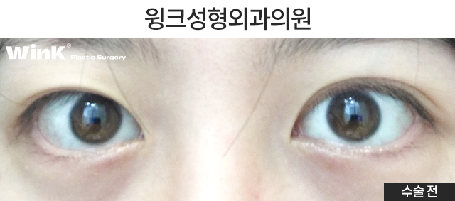 자연유착 재수술 시 주의점에 대해 알아보겠습니다. 관련 이미지 2