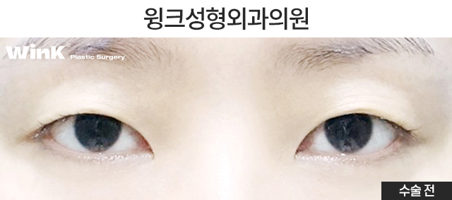Shall We Take a Look at the Symptoms of Double Eyelid Loosening? image 2