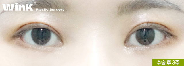 Are All Revision Eyelid Surgeries the Same? For High Crease "Sausage Eyes," Use Two-Line Technique to Lower the Front Line image 5