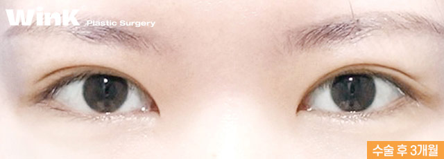 Wink’s Upper Blepharoplasty Revision Surgery, Considering Both Function and Aesthetics image 4