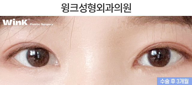 What Kind of Double Eyelids Suit Deep-Set Eyes? image 3