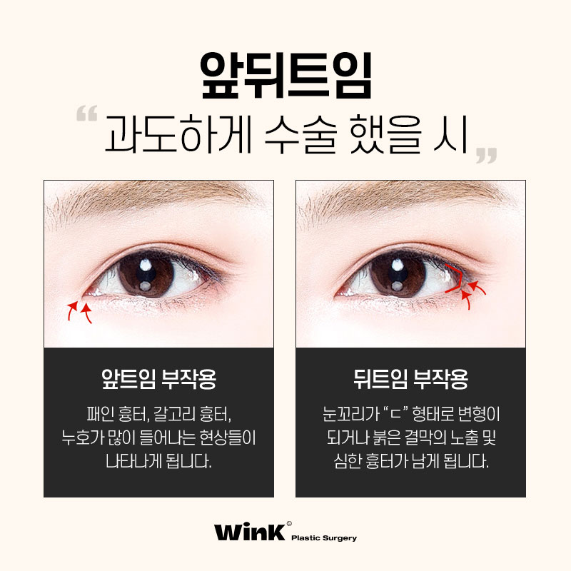 과도한 트임으로 부자연스러운 눈, 윙크성형외과 트임복원술로 해결하자! 관련 이미지 3