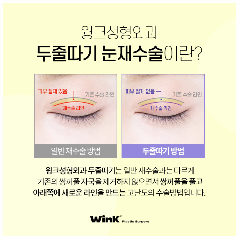 쌍꺼풀재수술 두줄따기눈재수술 윙크성형외과 소세지눈재수술 관련 이미지 3