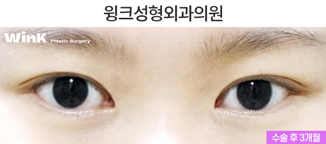 I Would Like to Talk About Natural Adhesion Double Eyelid Surgery. image 3
