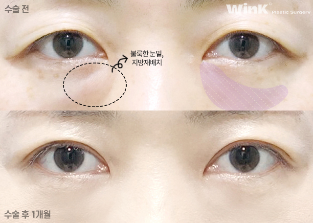 Lower Eyelid Fat Repositioning: Who Is It Effective For? image 7