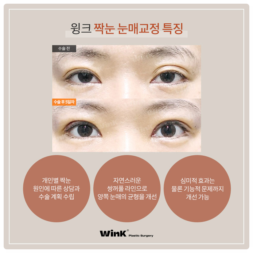 짝눈눈매교정술 잘하는곳? 비대칭짝눈교정 짝눈쌍수 잘하는 윙크성형외과 눈매교정짝눈! 관련 이미지 7