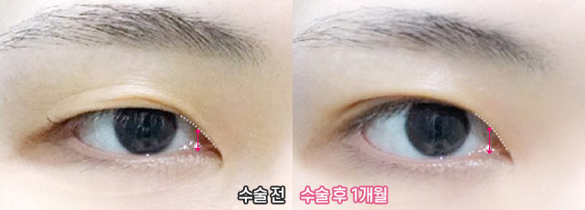 Wink Canthoplasty That Gently Lifts for a More Defined, Clear Eye Shape! image 10