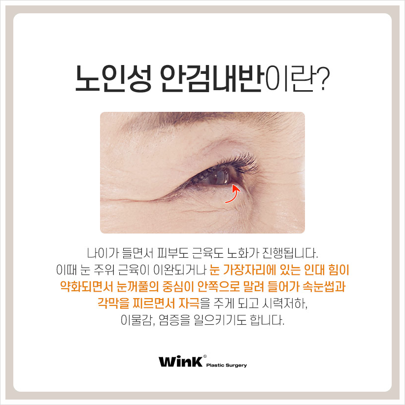 Lower Eyelid Entropion, Eyelashes Poking the Eye, Wink Plastic Surgery, Before and After Entropion Surgery image 2