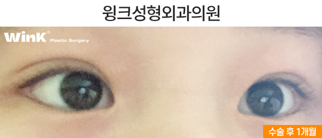 중학생 쌍커풀수술에 대해 알아볼까요? 관련 이미지 11