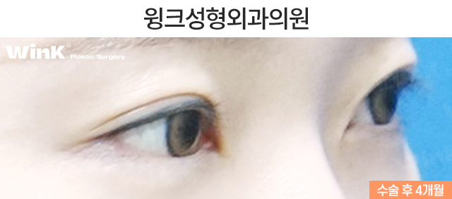 Case Examples of Correcting Uneven Eyes Through Ptosis Correction image 5