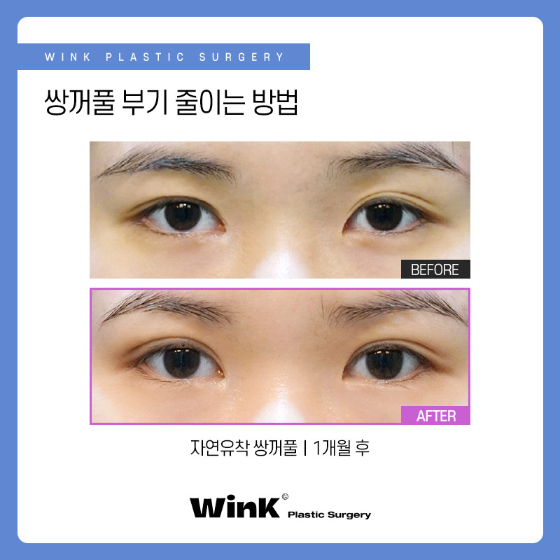 신사역쌍꺼풀수술 후 부기 빨리 빼고 싶다면? 눈수술후관리법 관련 이미지 4