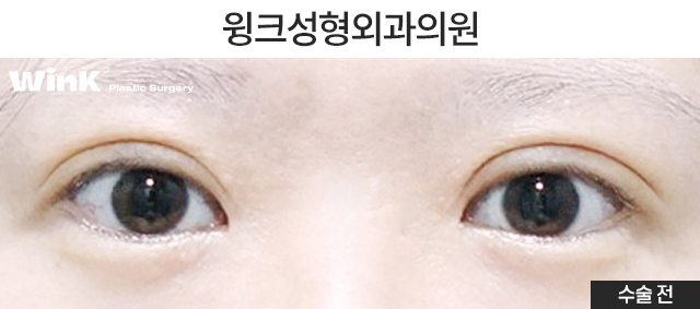 두줄따기 절개 눈재수술로 소세지눈에서 벗어나 볼까요? 관련 이미지 2