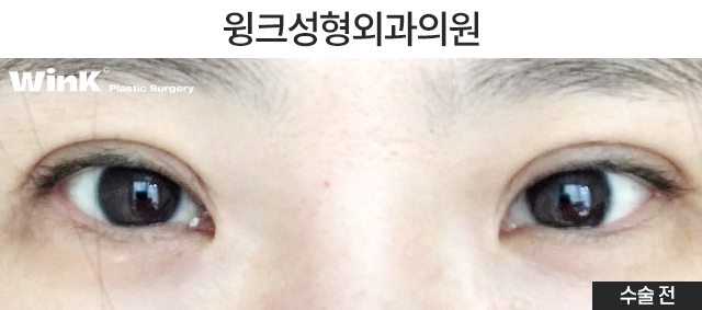 Turning a Thick Outer-Line Double Eyelid into a Natural Inline Through Double-Fold Revision image 5
