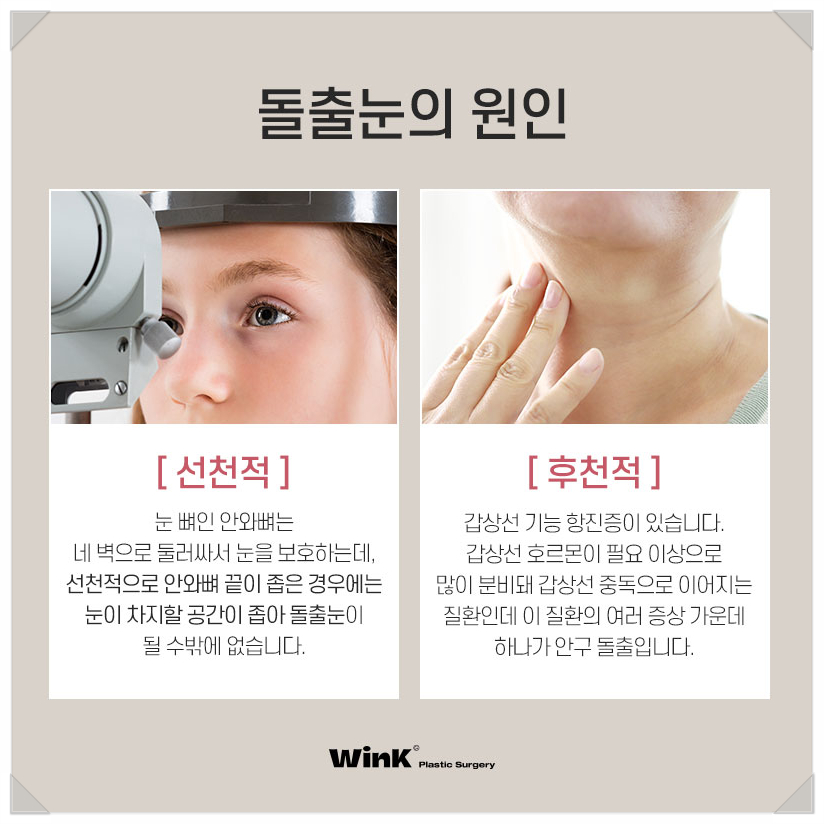Post-Op Review of Protruding Eyes Surgery, Sunken Eye Fat Grafting, Wink Plastic Surgery Upper Eyelid Fat Repositioning Price, Protruding Eye Fat Grafting image 3