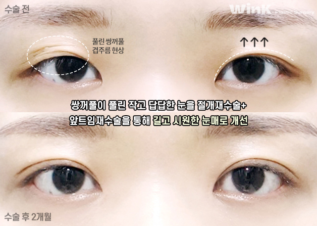 How Should Double Eyelid Surgery Be Performed for Small, Narrow Eyes? image 7
