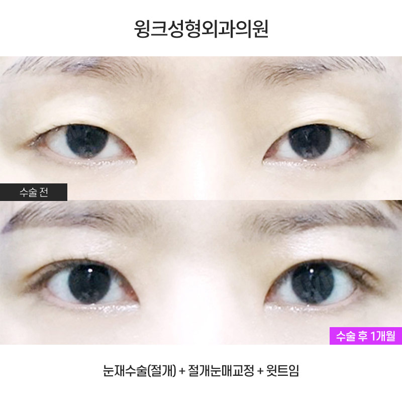 Shall We Take a Look at the Symptoms of Double Eyelid Loosening? image 1
