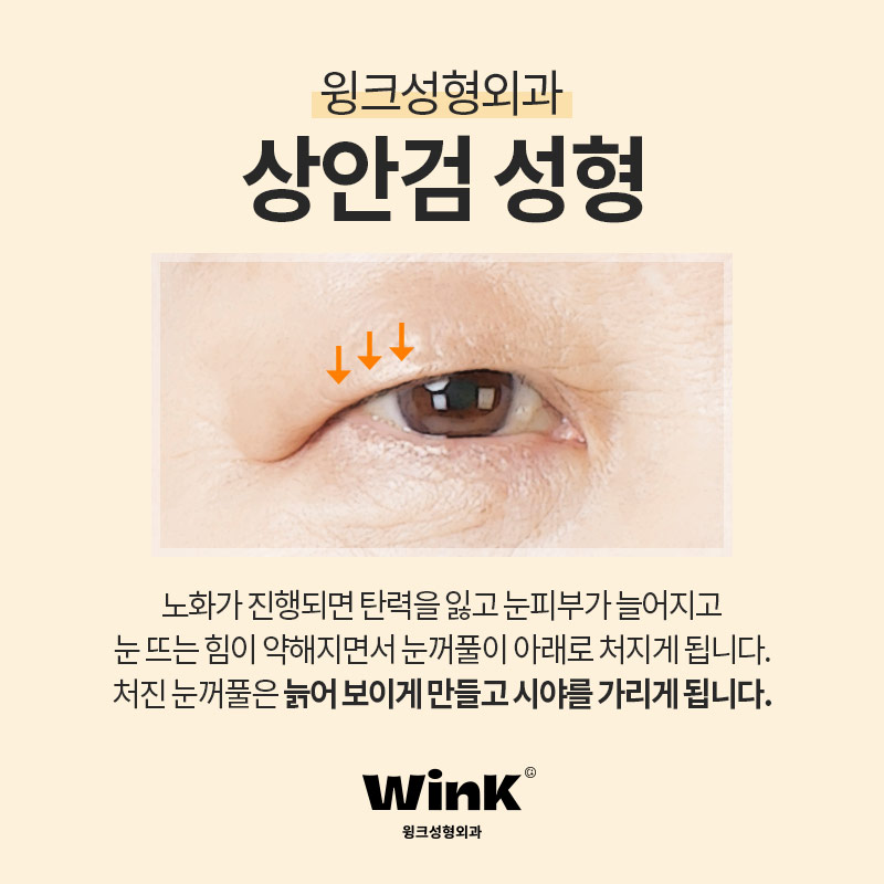 A More Youthful Eye Shape Through Wink Upper Blepharoplasty image 2