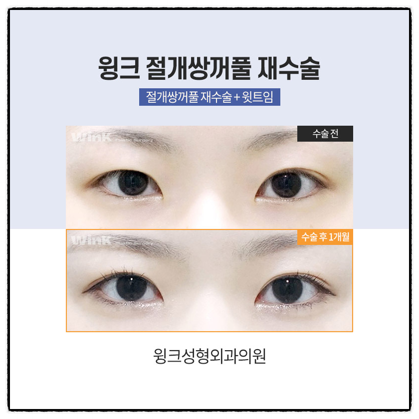 쌍꺼풀절개재수술 절개쌍수재수술후기로 흉터부터 회복까지 알아보자! 관련 이미지 3
