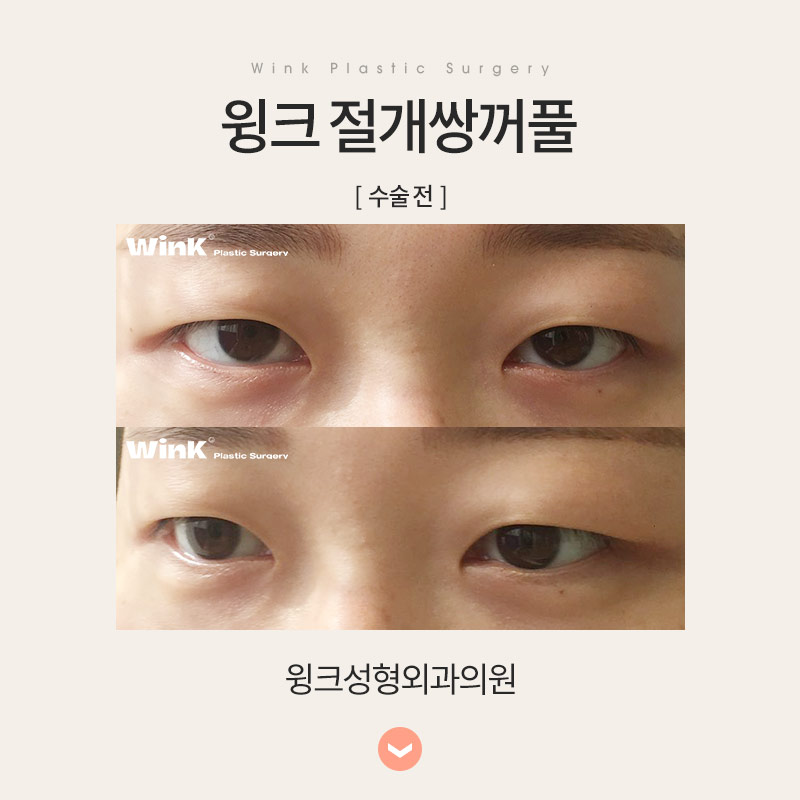 Let’s Learn About Incisional Double Eyelid Surgery image 6