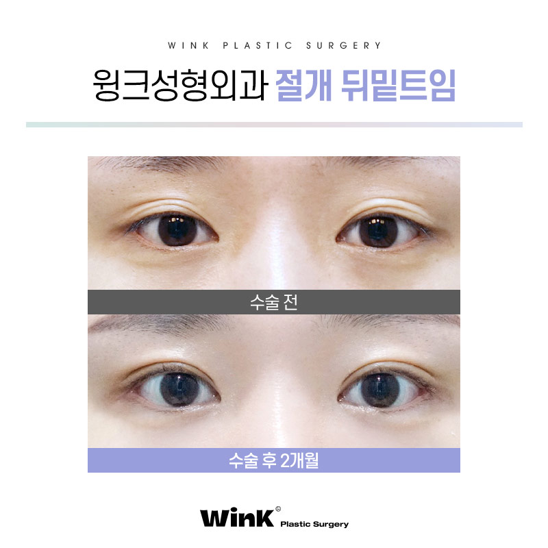 트임성형의 모든것! 눈밑트임잘하는곳 신사트임잘하는곳 관련 이미지 3