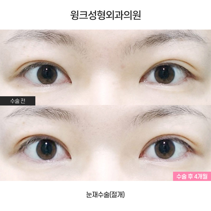 Shall We Learn About Revision Double Eyelid Surgery? image 1