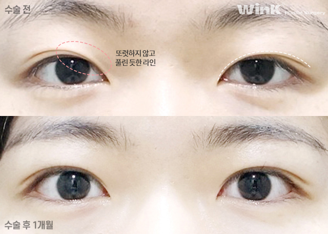 Should We Leave Eyelid Tape and Eyelid Glue Behind with Natural Adhesion Double Eyelid Surgery? image 7