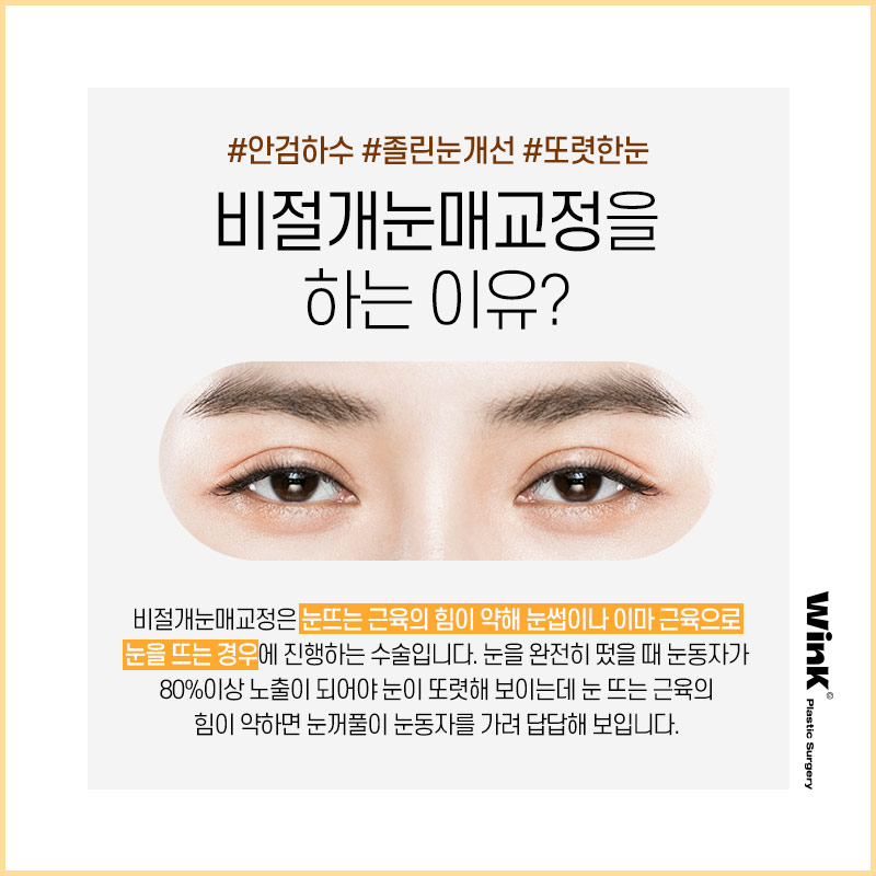 Wink Plastic Surgery’s Non-Incisional Ptosis Correction for Clearer Eyes Without an Incision! image 2