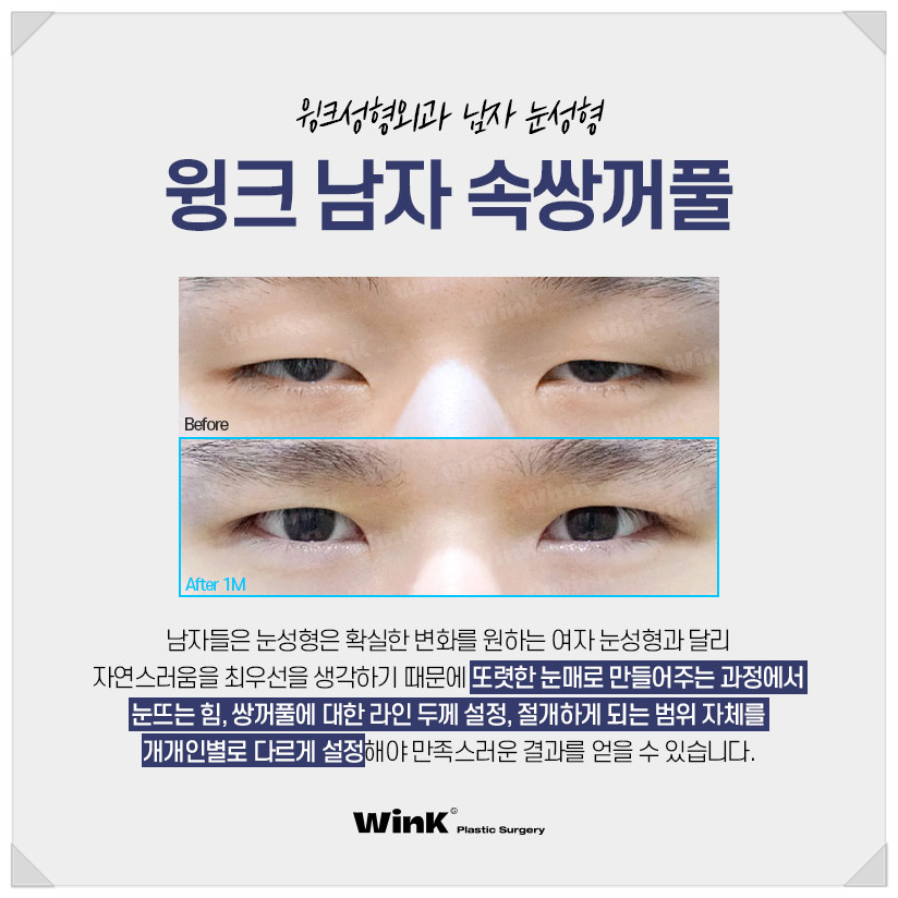 신사남자눈성형전후 남자쌍꺼풀수술 윙크성형외과 남자쌍수 속쌍꺼풀수술 관련 이미지 7