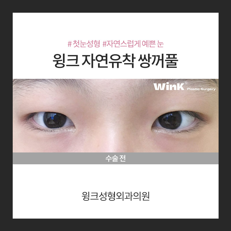 자연유착 쌍꺼풀 수술에 대해 알아보겠습니다. 관련 이미지 3