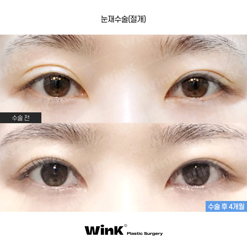높은 쌍꺼풀 라인, 겹쌍꺼풀과 같은 유형의 눈재수술 방법은? 관련 이미지 1