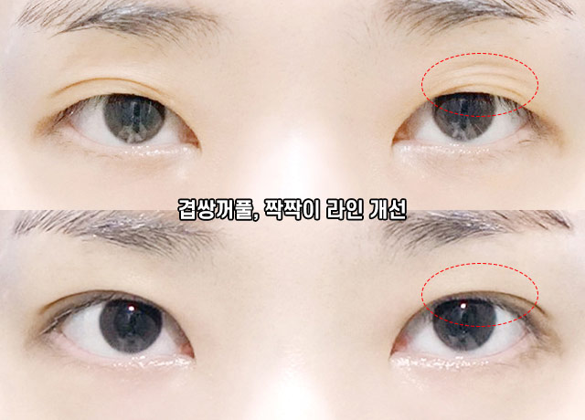 윙크성형외과에서 알려드리는 적절한 눈재수술 시기 관련 이미지 10