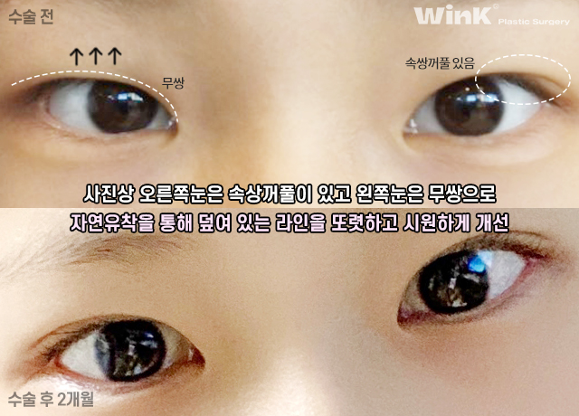 중학생 쌍커풀수술에 대해 알아볼까요? 관련 이미지 9