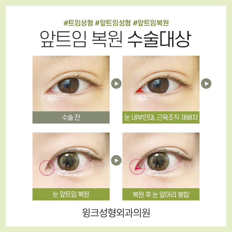 트임복원) 과도하게 트인 앞트임부작용을 앞트임복원으로 깔끔하고 자연스러운 결과 관련 이미지 3
