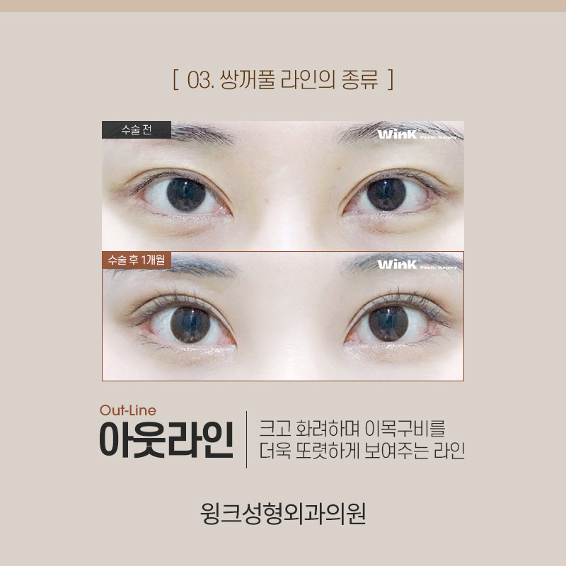 인아웃연예인은 누가 있을까? 윙크성형외과와 알아보는 쌍꺼풀 라인 종류! 관련 이미지 6