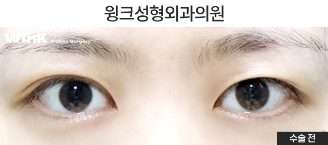Shall We Take a Look at the Symptoms of Double Eyelid Loosening? image 5