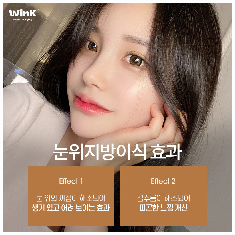 꺼진눈지방이식후기 눈두덩이지방이식 윙크성형외과 눈꺼풀꺼짐수술 관련 이미지 6