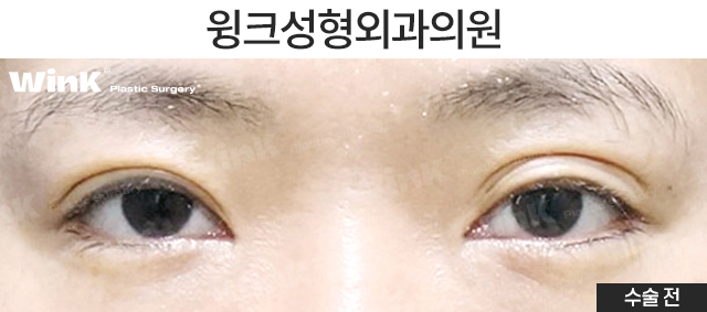 마지막 눈 성형, 눈매교정으로 또렷하게 개선해 드리는 윙크성형외과 눈재수술! 관련 이미지 2