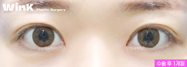 If you want to create the double eyelid line you want without being limited by your eye shape, Wink Incision Double Eyelid Surgery! image 4